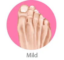 Mild Bunion Symptoms