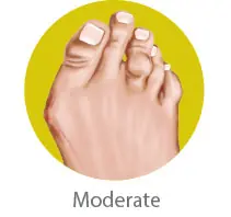 Moderate Bunion Symptoms