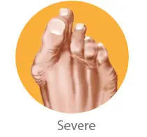 Severe Bunion Symptoms