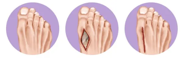 Lapidus Bunion Surgery Illustration